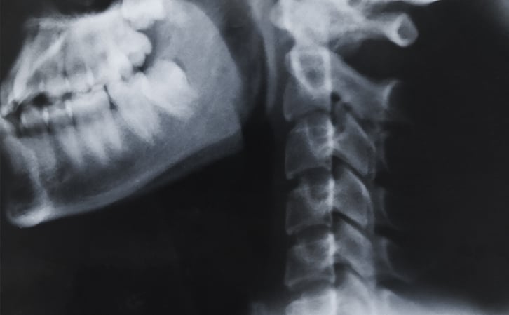 everything-you-need-to-know-about-c1-and-c2-vertebrae